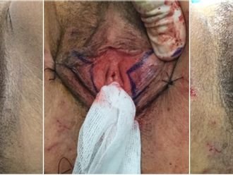 Vaginoplastie avant et après - 826624