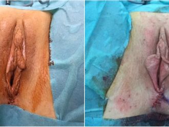 Vaginoplastie avant et après - 826683