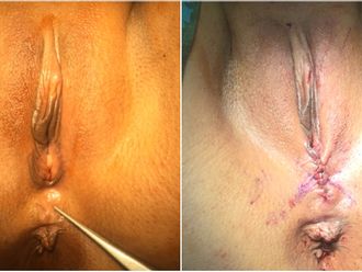 Vaginoplastie avant et après - 826684