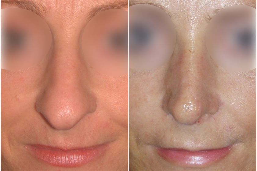 Rhinoplastie avant et après - 839742