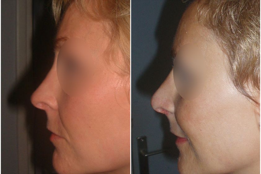 Rhinoplastie avant et après - 839743