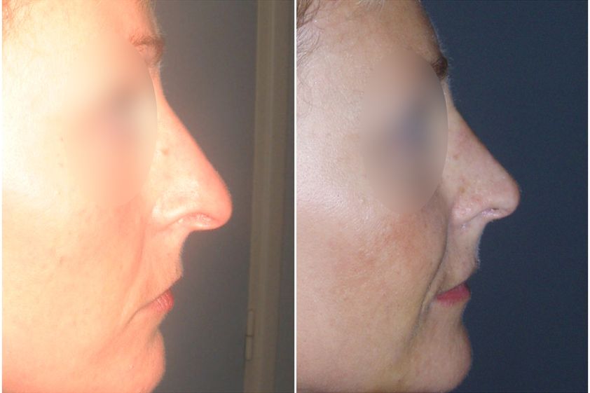 Rhinoplastie avant et après - 839744