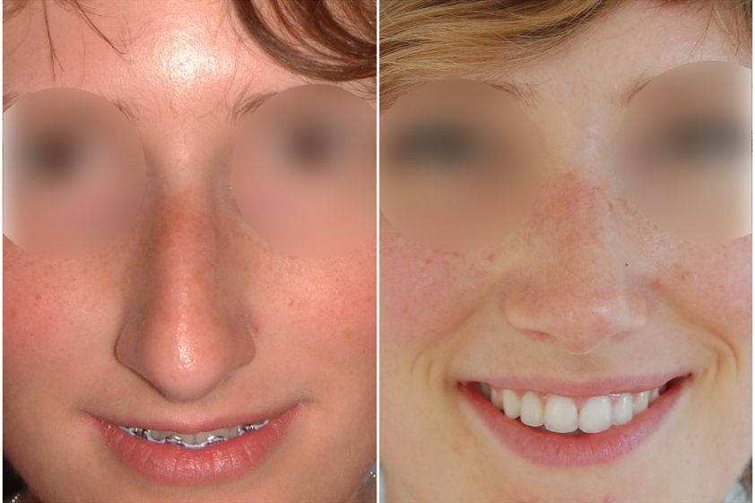 Rhinoplastie avant et après - 839745