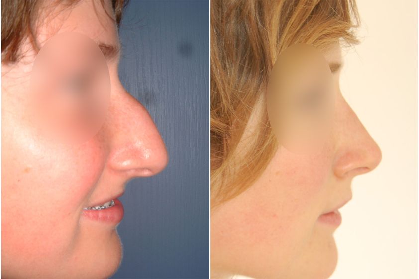 Rhinoplastie avant et après - 839746