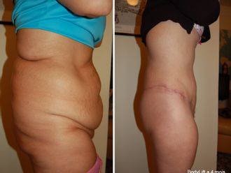 Bodylift avant et après - 839800
