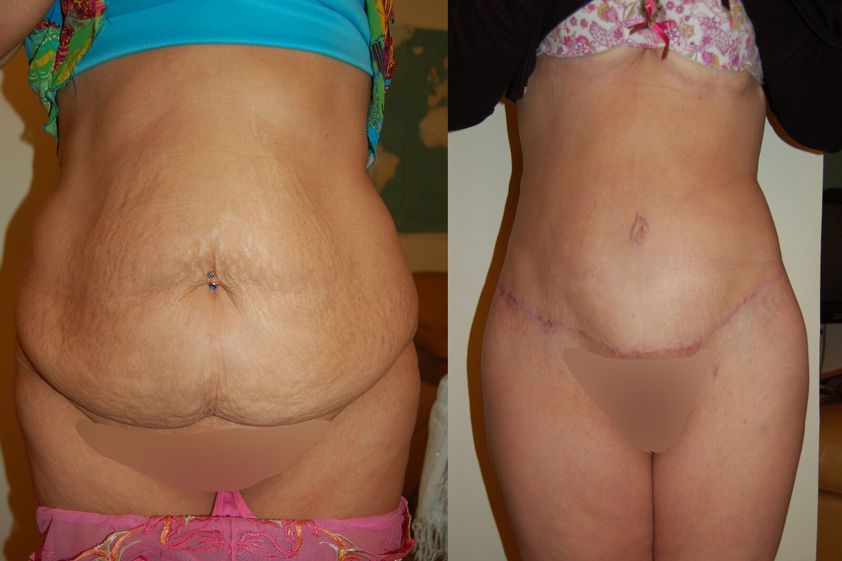 Bodylift avant et après - 839801
