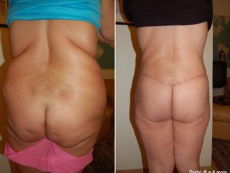 Bodylift avant et après - 839802