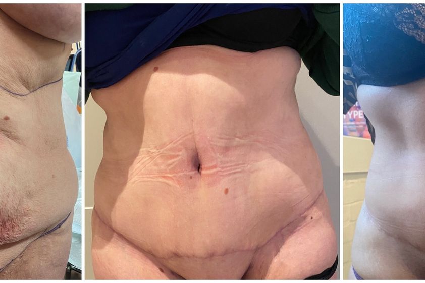 Abdominoplastie avant et après - 864804