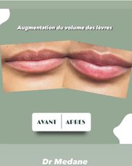 levres