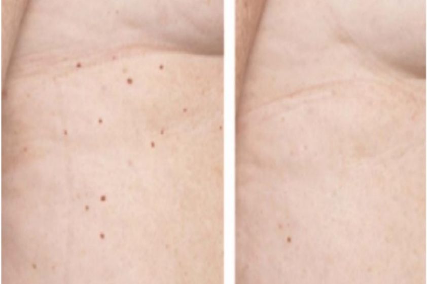 Grains de beauté avant et après - 559873