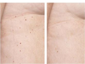 Grains de beauté - 559873