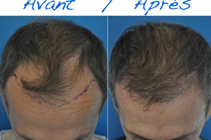 Greffe de cheveux avant et après - 542445