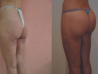 Avant après lipofilling des fesses