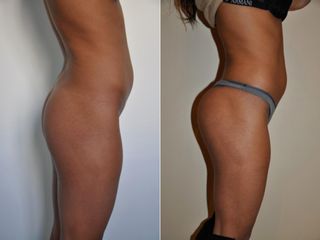 Avant après Chirurgie des fesses