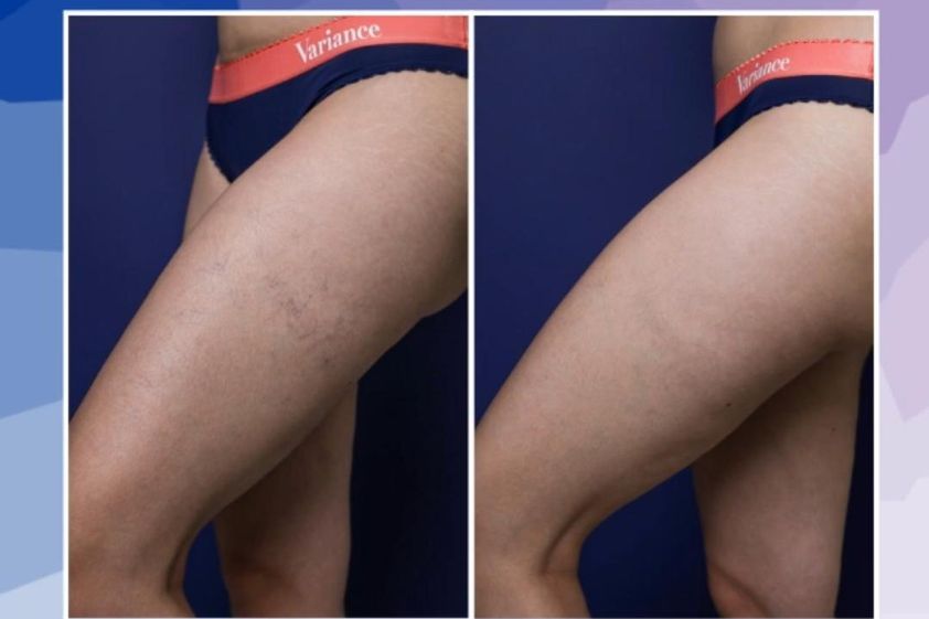 Varices avant et après - 698963