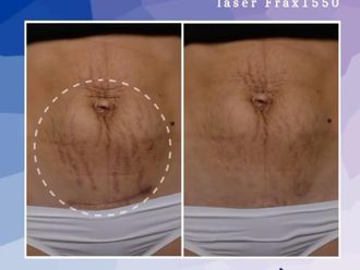 Varices avant et après - 698975