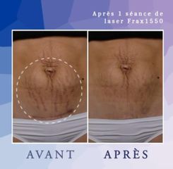 Varices - Dr Diala Haykal - Centre Medical Laser Esthetique Palaiseau
