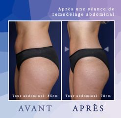 Radiofréquence - Dr Diala Haykal - Centre Medical Laser Esthetique Palaiseau