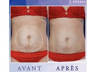 Radiofréquence - Dr Diala Haykal - Centre Medical Laser Esthetique Palaiseau