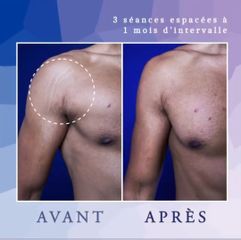 Vergetures - Dr Diala Haykal - Centre Medical Laser Esthetique Palaiseau
