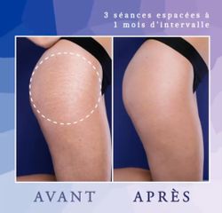Vergetures - Dr Diala Haykal - Centre Medical Laser Esthetique Palaiseau