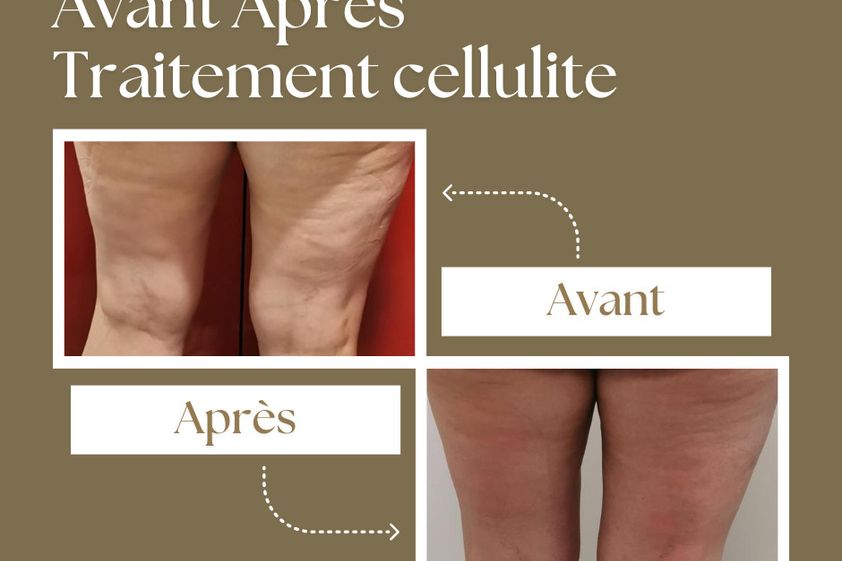 Radiofréquence avant et après - 848960