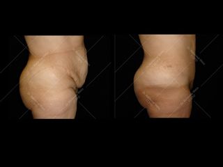 Avant après Abdominoplastie