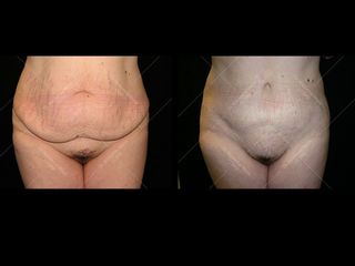 Avant après Abdominoplastie