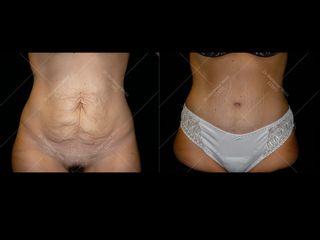Avant après Abdominoplastie