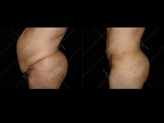 Avant après Abdominoplastie
