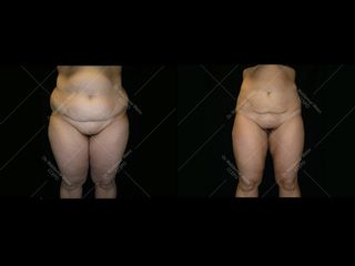 Avant après Liposuccion