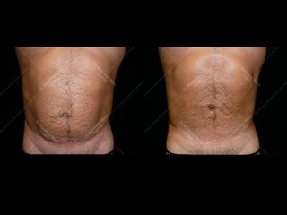 Avant après Liposuccion