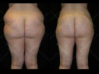 Avant après Liposuccion