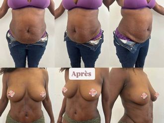 Abdominoplastie avant et après - 878261