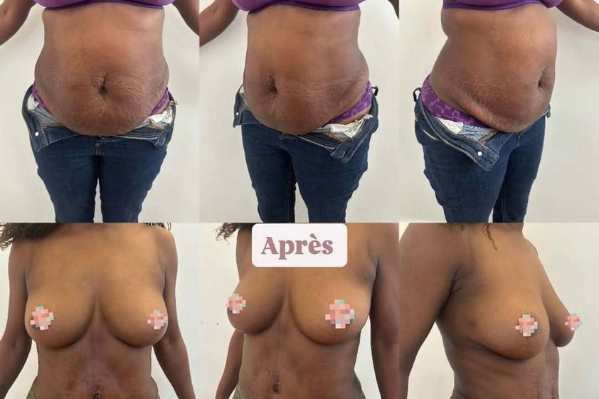 Abdominoplastie avant et après - 878261
