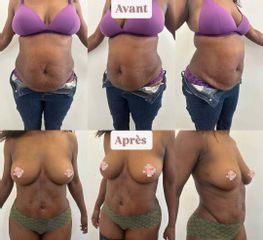 Abdominoplastie et Liposuccion