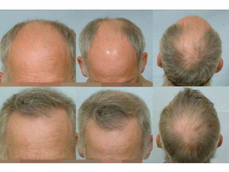 Implants capillaires - 584017