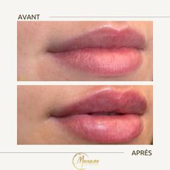 Augmentation des lèvres - Centre Laser Murano - Épilation & Médecine Esthétique