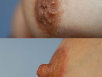 Chirurgie reconstructrice avant et après - 792748