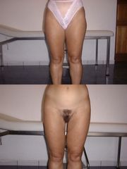 Lifting des cuisses - Dr Roland Kolbe & Dr Anne Kolbe