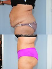 Abdominoplastie - Dr Roland Kolbe & Dr Anne Kolbe