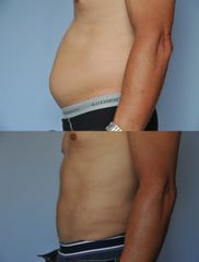 Lipoaspiration abdomen - Dr Roland Kolbe & Dr Anne Kolbe
