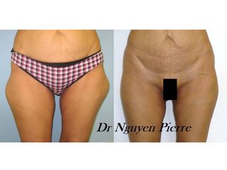 Avant après Liposuccion