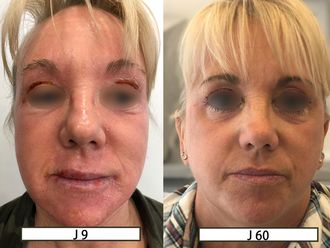 Peeling - 629112