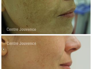 Avant après peeling depigmentant 