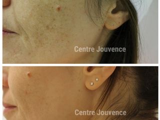 Avant après peeling depigmentant 