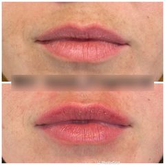 Augmentation des lèvres - Dr David Fragnieres