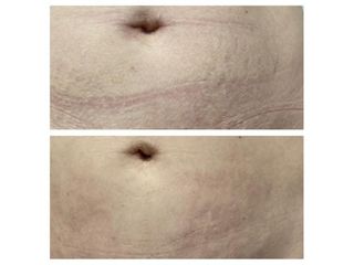 Vergetures - Dr Mahboubeh Charlot