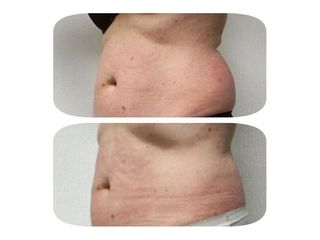 Cryolipolyse - Dr Mahboubeh Charlot