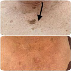 Taches pigmentaires - Dr Mahboubeh Charlot
